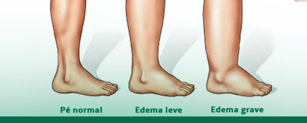 Veamos Edema Linfático Que Es Veamos Edema Linfático Que Es